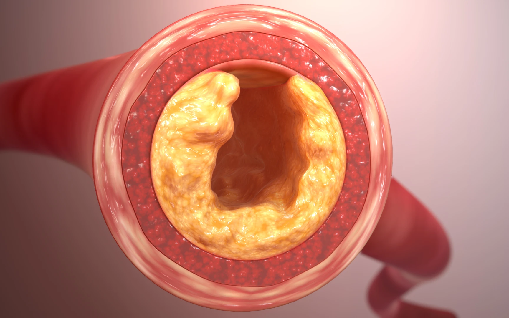 Jak snížit cholesterol: Osvojte si kroky, které jsou maximálně účinné